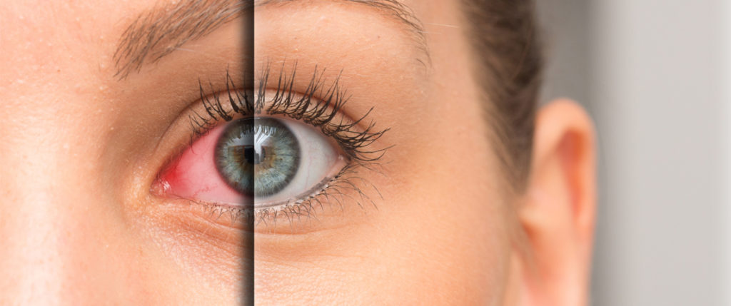 Comparing dry eye to normal eye